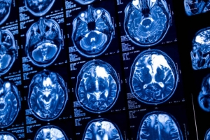 Gene Therapy Breakthrough Brings Hope for Huntington’s Disease