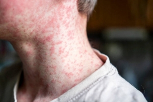 Measles Outbreak Grows in North London Boroughs